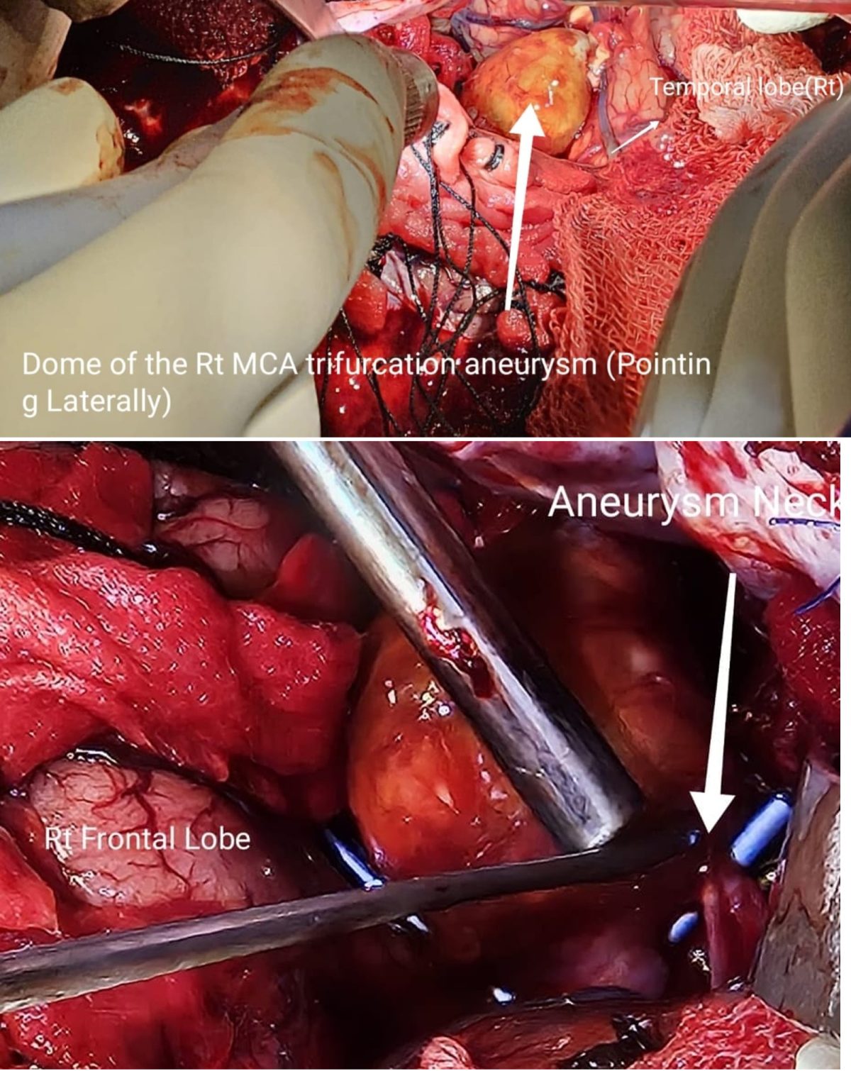 Sub Arachnoid Bleed : Aneurysm Surgery : தமனிக்கொப்புளம் : மூளையில் இரத்தக்கசிவு
